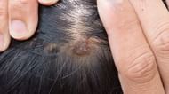 Scalp scabs (Image via Getty Images)